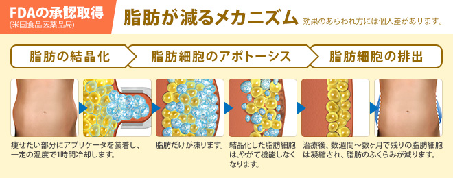 FDAの承認取得 (米国食品医薬品局) 脂肪が減るメカニズム 効果のあらわれ方には個人差があります。脂肪の結晶化/脂肪細胞のアポトーシス/脂肪細胞の排出/痩せたい部分にアプリケータを装着し、 一定の温度で1時間冷却します。/脂肪だけが凍ります。/結晶化した脂肪細胞 は、やがて機能しなく なります。/治療後、数週間〜数ヶ月で残りの脂肪細胞 は凝縮され、脂肪のふくらみが減ります。